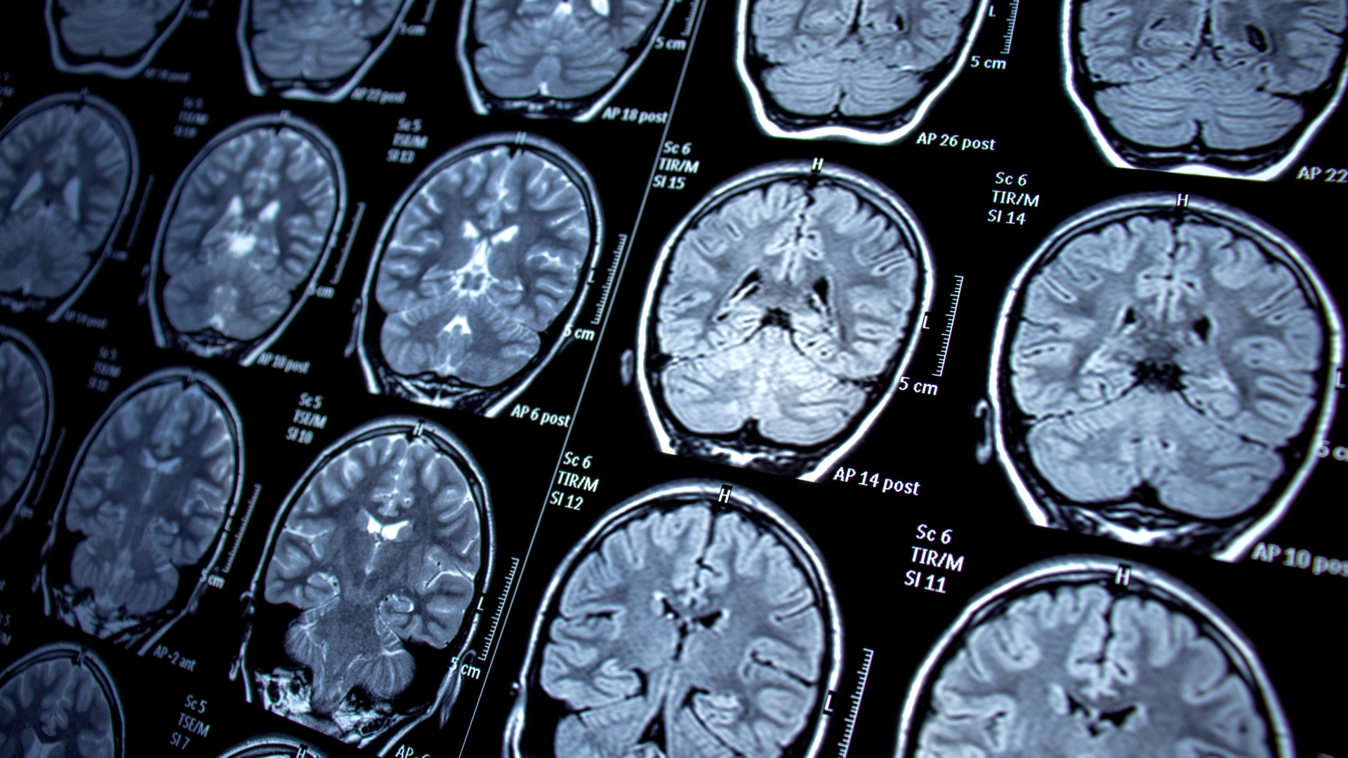 BATERÍA DE PREGUNTAS OFICIALES FEA NEUROLOGÍA PARA LA PREPARACIÓN DE LA OPE CESM CANARIAS